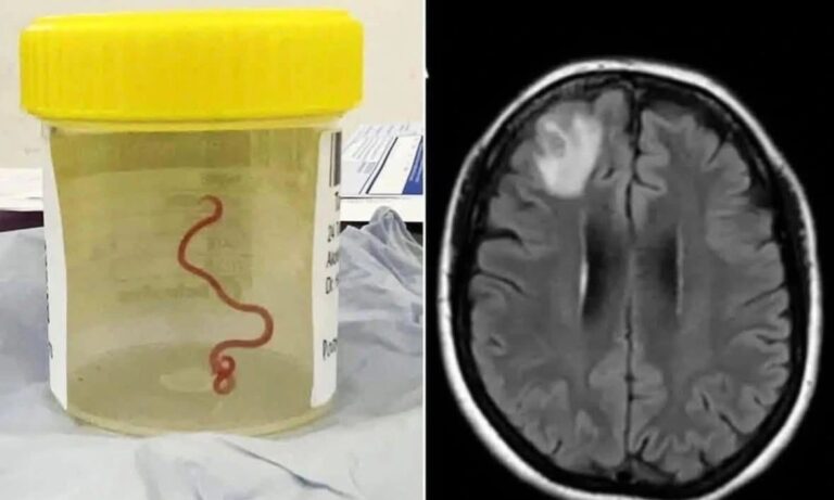 Australia, Ophidascaris robertsi, live worm in brain, python parasite, Australian medical case, brain surgery, rare infection, zoonotic disease, neurosurgeon Australia, human parasite case, Ascendants News
