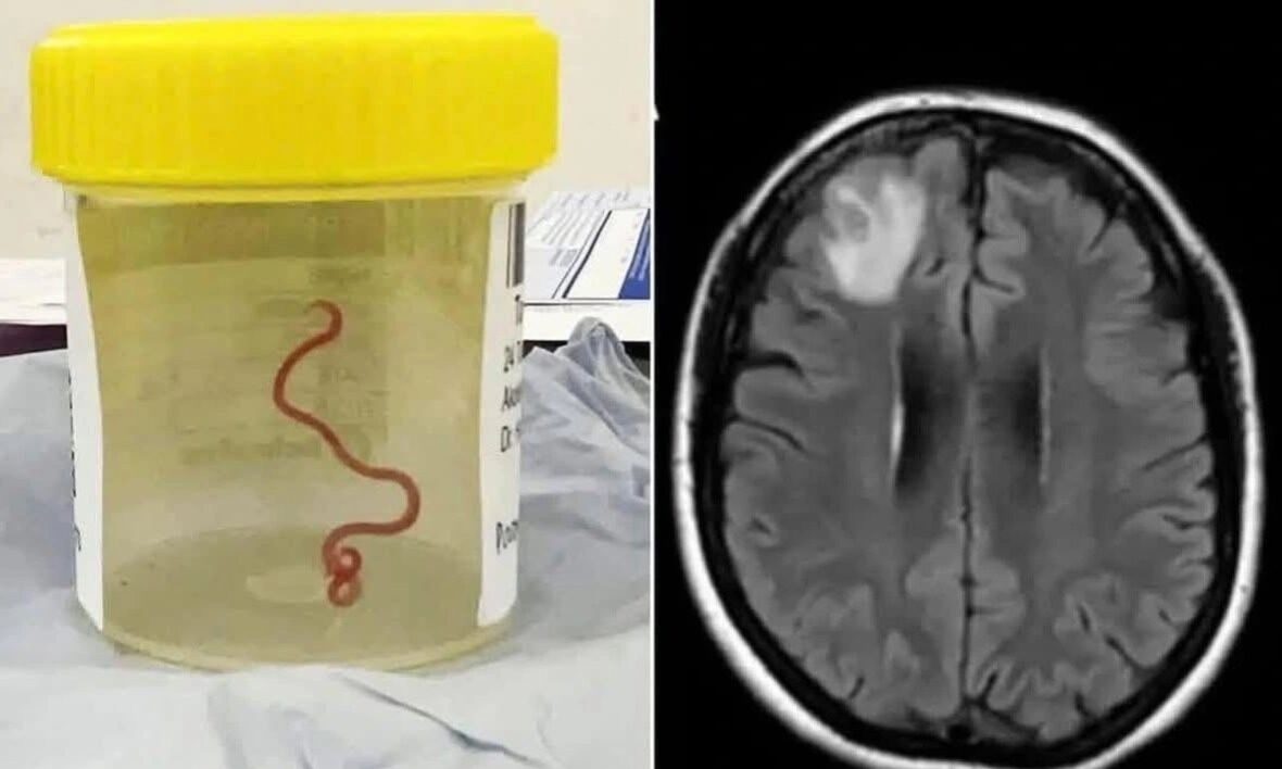 Australia, Ophidascaris robertsi, live worm in brain, python parasite, Australian medical case, brain surgery, rare infection, zoonotic disease, neurosurgeon Australia, human parasite case, Ascendants News