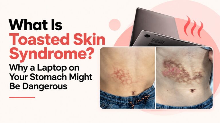 image explaining toasted skin syndrome, showing heat-related net-like skin discoloration on the abdomen alongside a laptop, with the headline “What Is Toasted Skin Syndrome?”